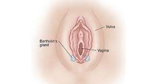 Image result for Bartholin's gland abscess