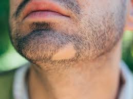 Well, it is normal for cats to shed their coat. Bald Patch In Beard Causes And Treatments
