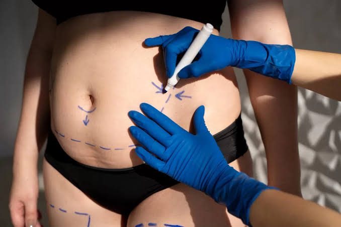 Body Fillers for Sculpted Contours - Dynasty Clinic