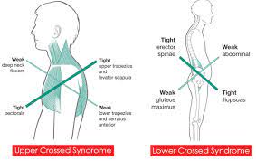 Cross Syndrome Causes Symptoms Diagnosis Treatment Exercises