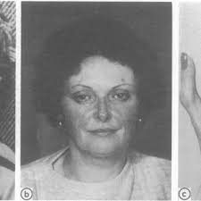 a and b Childhood and adultfacies ofmother ofcase S showing typical...