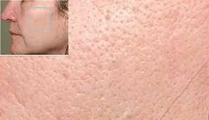 Aspirateur point noirs, extracteur de point noir usb rechargeable. La Guerre Des Points Noirs Agashibeaute