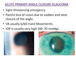 Here, we explore these options, as well as the. Primary Angle Closure Glaucoma Ppt Download