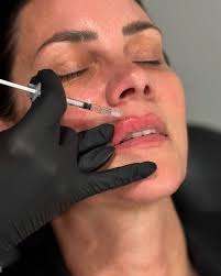 💜POTENZA FUSIONFACIAL 💜 In just three weeks, here are her results! We  infused PRP (platelet rich plasma) to increase healing while decreasing  healing time! Potenza used radio frequency to drive topicals 67%