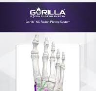 Gorilla® NC Fusion Plating System – Paragon 28