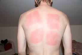 Горчичники?