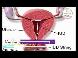 اللولب النحاسي، وتصل كفاءة كل منهم في منع الحمل إلى ما لا كيف تستطيعين معرفة أنك حامل فوق اللولب؟ بالنسبة للولب النحاسي، فإن وجوده لا زيادة الوزن والسمنة عند الأطفال. Ù‡Ù„ Ø§Ù„Ù„ÙˆÙ„Ø¨ ÙŠØ²ÙŠØ¯ Ø§Ù„ÙˆØ²Ù† Ù…Ù…ÙŠØ²Ø§Øª ÙˆØ¹ÙŠÙˆØ¨ Ø§Ù„Ù„ÙˆÙ„Ø¨ Ø¯ Ø±ÙŠÙ‡Ø§Ù… Ø§Ù„Ø´Ø§Ù„ Ù…ÙˆØ«Ù‚ Youtube