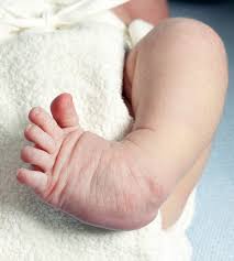 In clubfoot, the tissues connecting the muscles to the bone (tendons) are shorter than usual. New Tool To Assess Clubfoot Treatment Lower Extremity Review Magazine