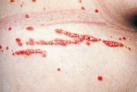 Image result for koebner phenomenon psoriasis