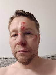 Runner's experience with tripping and falling during a run