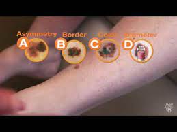 music playing the first thing to do when a patient is diagnosed is i tell that patient, this is a scary m. Mayo Clinic Minute Raise Your Skin Cancer Iq Youtube