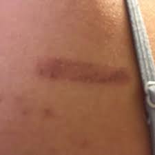 Ich habe so ein lasergerät von rio zuhause. Werden Diese Durch Ipl Haarentfernung Verbrannten Stellen Zum Narben Gesundheit Und Medizin Laser Verbrennung