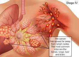 What they found seems really different from what happens in other animals, says vincent lynch , an evolutionary cancer biologist at the university of chicago. Breast Cancer Signs Symptoms Stages Treatment About Risk Factors Ashray