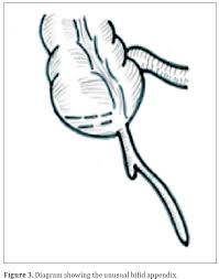 Bifid Appendix Its Embryologic Explanation And Clinical Implications