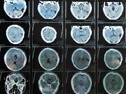 Image result for Postconcussion Syndrome