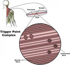 Myofascial Pain Syndrome Often Leaves Doctors Baffled And Patients Untreated The Washington Post