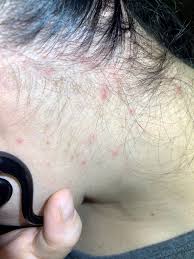 More severe reactions cause marked reddening, blistering and swelling of the eyelids, scalp, face and neck. I Got A Chemical Rash From Hair Dye At A Salon Anybody Recommend A Soothing Remedy Fancyfollicles