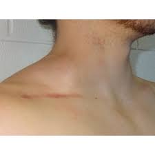 Swollen lymph nodes, a fever and night sweats may also be symptoms of the cold and flu. Unilateral Supraclavicular Mass In A Division I Male Collegiate Cheerleader