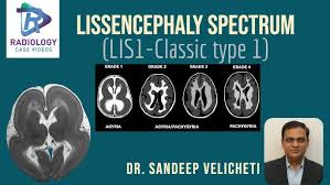 There's no cure, but children with the condition can make progress over time. Lissencephaly Spectrum Classic Type1 Sandeep Velicheti Understanding Lissencephaly Microscopic Level Youtube