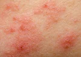 Insect Bite Allergies Crystal Lake Treat Insect Bite Crystal Lake Allergist Crystal Lake Il 60014