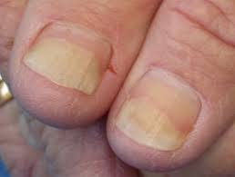 Image result for Onycholysis feet
