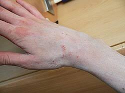 Image result for scabies human bites