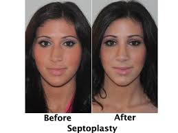 Before And After Views Of A Female Patient Who Underwent A Septoplasty Procedure With Dr Bennett Nose Surgery Reduction Surgery Liposuction