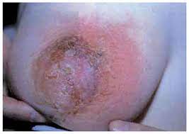 La structure de la glande mammaire est inachevée. Infections Du Sein