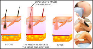 Choose suitable device for skin and hair color. Laser Hair Removal Reviews Avoid Laser Hair Removal At Home