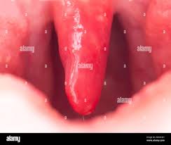 Image result for Uvulitis
