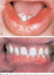 Figure 3 From Crohn S Disease With Oral Presenting Signs Masquerading As Chronic Osteomyelitis Semantic Scholar
