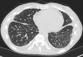 Choose from a wide range of similar scenes. A 42 Year Old Woman With Abnormal Chest Ct Scan And Chylous Ascites Chest