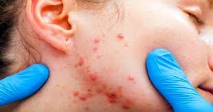 Iltihapli Sivilceye Ne Iyi Gelir Iltihapli Sivilce Tedavi Yontemleri