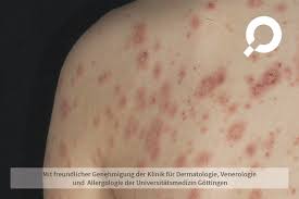 There are two main types of pl: Pityriasis Rosea Roschenflechte Dermanostic Hautlexikon