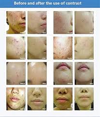 FEITA 7 Colors LED Photon Light Therapy Skin Care Machine