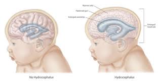 Image result for Hydrocephalus