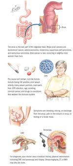 Only a medical professional can determine the cause of your symptoms. Anal Cancer Colorectal Cancer Spectrum Health