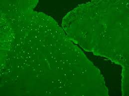 Read about testicular cancer (cancer of the testicle), including information about symptoms, causes, diagnosis and treatment. Scientists Discover Autoimmune Disease Associated With Testicular Cancer Uc San Francisco