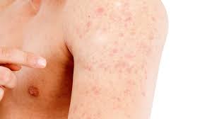 Image result for sweat rash on back