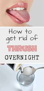 How To Get Rid Of Thrush Overnight Beautytutorial Org Overnight Beauty Oral Thrush Remedies Home Remedies For Thrush
