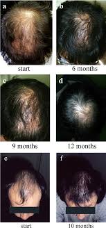 Nizoral is a hair loss treatment available in a shampoo to help restore hair growth. Nizoral For Hair Loss Uphairstyle