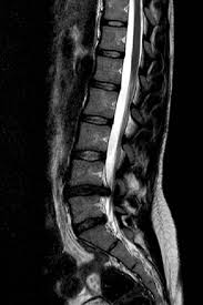 Image result for vyhřezlá ploténka