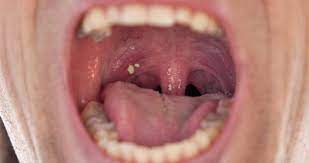 Ubat mata kucing paling mujarab. 5 Bahan Ini Berkesan Merawat Tonsil Secara Tradisional Maskulin