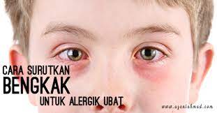 Jom kami kongsikan petua hilangkan bengkak khas untuk anda. Cara Surutkan Bengkak Untuk Alergik Ubat Azeniahmad Com