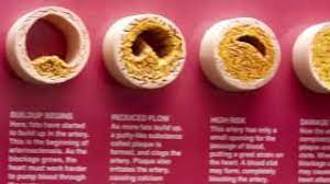 Symptoms of clogged arteries in the neck if you're overweight, and dieting and exercise haven't worked for you. Blocked Carotid Arteries Youtube