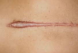 How Long Does It Take A Hypertrophic Scar To Heal Scars And Spots Invicible