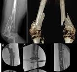 Double fixation for complex distal femoral fractures in ...