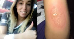 A subungual hematoma is a collection of blood underneath a toenail or fingernail (black toenail). Michigan Woman Treated For Brown Recluse Spider Bite Cbs News
