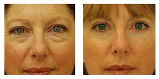 Blepharoplasty Nyc Eyelid Surgery Eye Lift Dr David Rosenberg Eye Surgery Eye Lift Eyelid Surgery