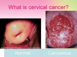 Check spelling or type a new query. Cervical Cancer Prevention What Is The Cervix The Cervix Is The Lower Narrow Portion Of The Uterus Womb Where It Joins With The Top End Of The Vagina Ppt Download